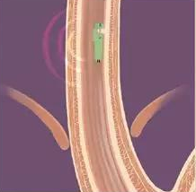 肠道医生胶囊窥视镜的高端微型晶振功能模块